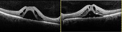 Retinal detachments in a patient with minimal change nephrotic syndrome: Case report and review of the literature